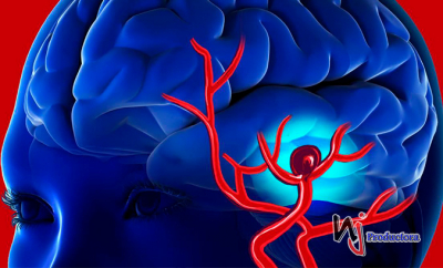 4 nociones básicas para afrontar una rotura de aneurisma cerebral