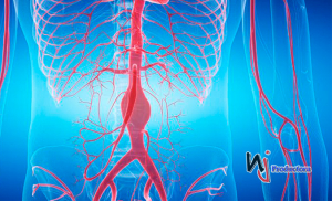Aneurisma de aorta: claves de una amenaza que no avisa