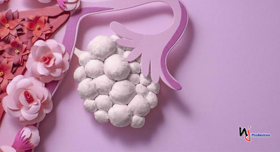 Detección tardía del síndrome de ovario poliquístico podría causar infertilidad en la mujer