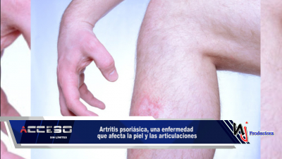 Artritis psoriásica, una enfermedad que afecta la piel y las articulaciones