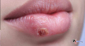 Cómo evitar y tratar la infección del herpes labial